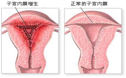 子宫内膜增厚饮食注意 子宫内膜增厚的饮食