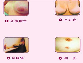 乳腺癌有什么前兆 乳腺癌的症状是什么？