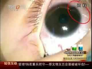 眼睛黄斑病治疗方法 眼睛寄生虫如何治疗 眼睛寄生虫治疗方法