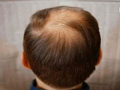 雄性脱发症状 雄性脱发的症状 雄性脱发的原因