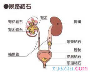 尿结石患者吃什么好 尿结石吃什么好 尿结石患者不能吃什么