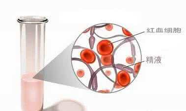 怎么预防血精 血精怎么形成的 血精的治疗预防