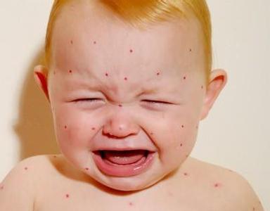 蚊虫叮咬止痒消肿 怎样防蚊虫，幼儿冰敷患处止痒效果最佳