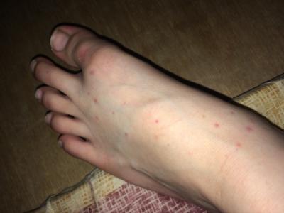 为什么蚊子喜欢咬脚 蚊子为什么叮脚