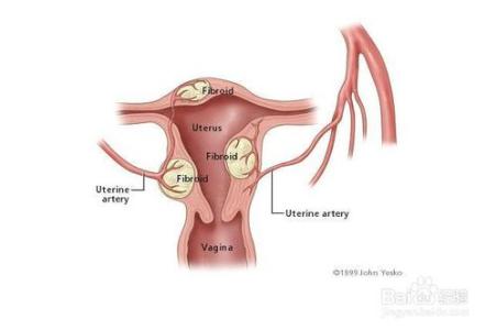 子宫肌瘤 提早发现子宫肌瘤将伤害降到最低
