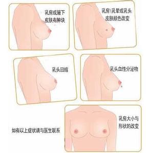 乳腺增生和乳腺癌图片 乳腺增生症状有哪些