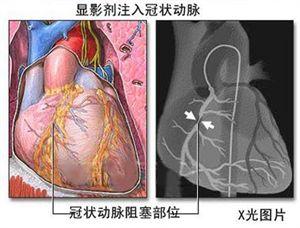 支架手术后的饮食食谱 心脏支架手术后吃什么好