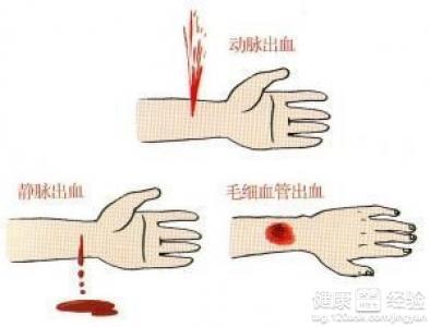 脚趾出血怎么止血 出血和止血