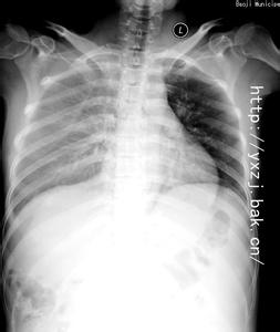 肺积液最严重会怎样 肺积液是怎样形成的
