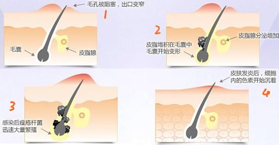 一个痘痘的形成过程 痘痘是如何形成的