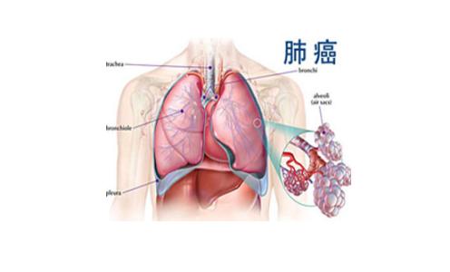 肺部结节是怎么形成的 肺部节灶怎么形成的