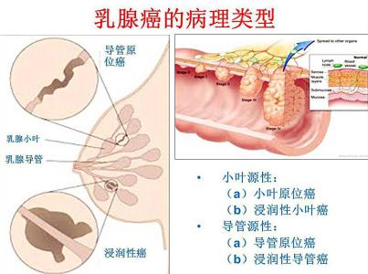 乳腺癌的预防与治疗 乳腺癌是怎样形成的 乳腺癌的治疗和预防方法