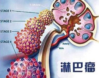 淋巴瘤形成要多久 淋巴瘤是怎么样形成的