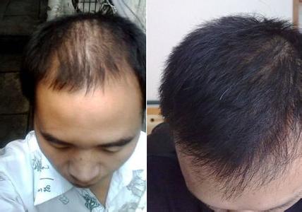 头顶脱发原因及治疗 头顶出油脱发怎么办 头顶出油脱发的治疗