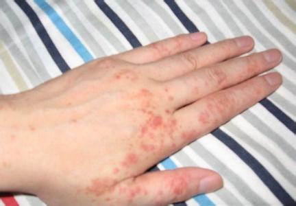 湿疹的症状和图片 湿疹症状