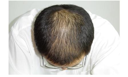 治疗头顶脱发的方法 头顶脱发如何治疗 头顶脱发的治疗方法