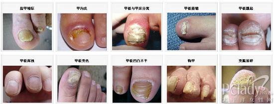 灰指甲怎么根治 灰指甲是怎么引起的 灰指甲怎么治