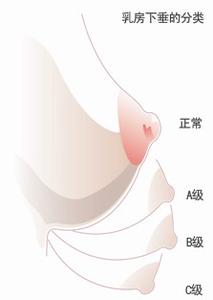 改善乳房下垂 五大秘诀助你改善乳房下垂