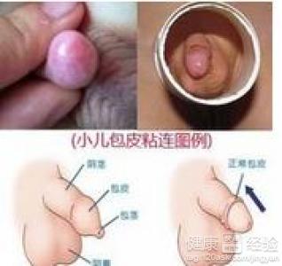 包皮垢是怎么形成的 宝宝包皮怎么形成的