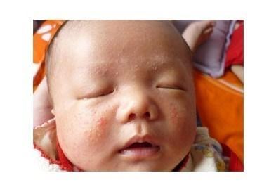 初生婴儿湿疹图片 婴儿湿疹怎么办？
