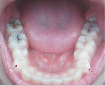 正常长智齿的症状图片 长智齿会有什么症状