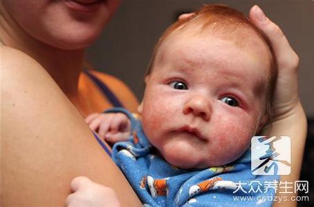 婴儿湿疹不能吃什么 婴儿宝宝湿疹不能吃什么
