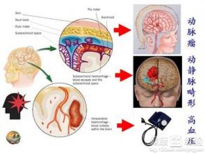 什么原因导致脑出血 什么原因会出现脑出血_脑出血的原因介绍