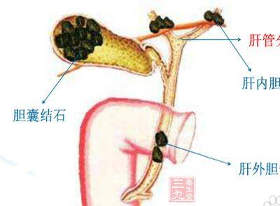 胆结石不能吃什么食物 胆结石不能吃什么