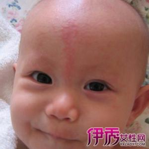 小孩出疹子的症状图片 幼儿出疹子的处理方法