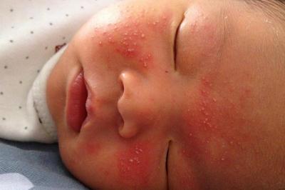 湿疹的原因及治疗方法 宝宝湿疹的原因及治疗方法