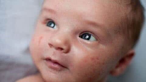 婴儿脸上常见皮肤病 婴儿得了奶癣怎么办