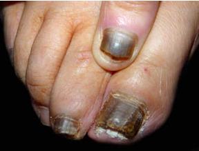引起灰指甲的原因 引起灰指甲的十点原因