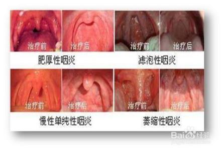 治慢性咽炎最佳方法 慢性咽炎如何治疗