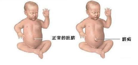 宝宝肚脐疝气怎么办 宝宝肚脐疝气是怎么形成的呢