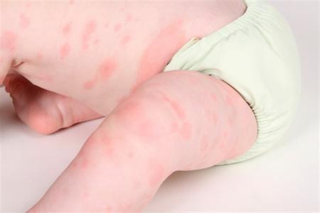 宝宝螨虫过敏症状图片 宝宝螨虫过敏有哪些症状