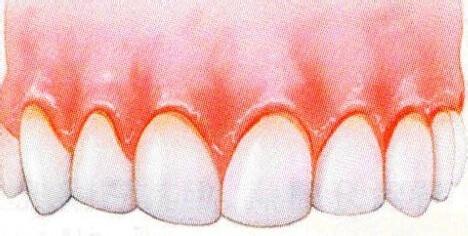 牙龈出血与肝病有关吗 牙龈出血是怎么回事
