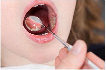口腔溃疡的治疗方法 治疗口腔溃疡的小妙方