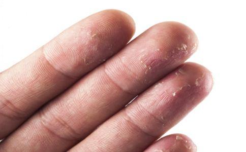 手脱皮是缺什么维生素 手脱皮是什么原因