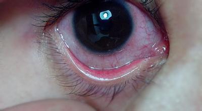 眼睛红血丝怎么消除 眼睛红血丝是怎么回事