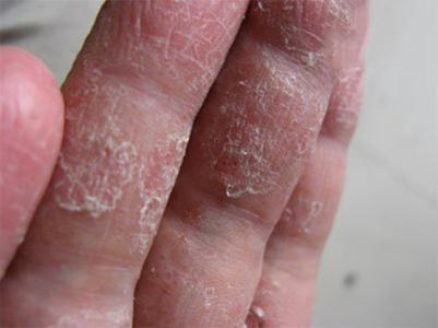 真菌感染皮肤病图片 生活中随时小心感染皮肤病