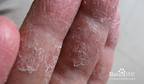 手脱皮的原因 哪些原因会导致手脱皮