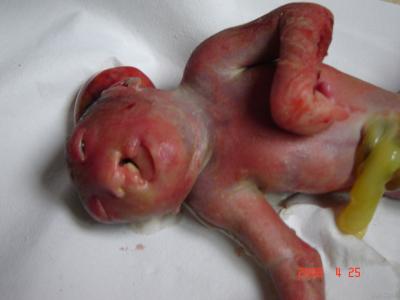 导致胎儿畸形的原因 导致胎儿畸形的12个原因