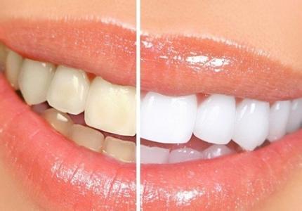 洗牙会造成牙齿松动吗 经常洗牙对牙齿好吗