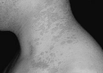 腋下汗斑对身体有危害 为什么会有汗斑