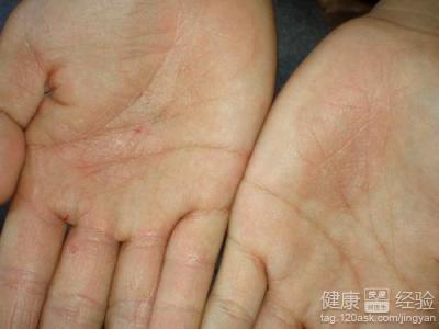 手部干燥性湿疹 防治手部干燥性湿疹