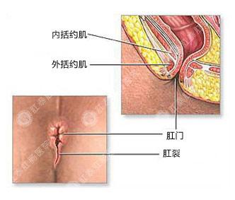 肛裂的治疗方法 肛裂是什么形成的 肛裂的治疗方法