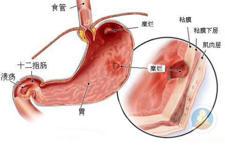 急性肠胃炎原因 急性胃炎是如何形成的_急性胃炎的原因