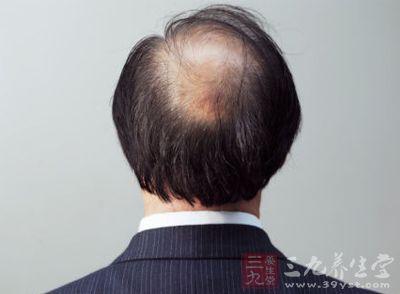 防脱发方法 怎样可以防脱发 可以防脱发的方法