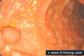 胃息肉手术后怎样调养 胃息肉是怎样形成的