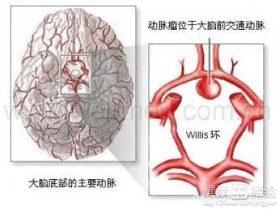 脑动脉瘤形成的原因 动脉瘤形成的原因